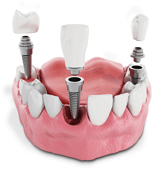 Dental Implant Cost Fairfield, CA Kuzma DDS
