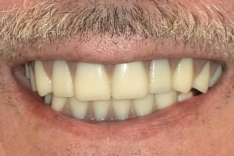 Before & After Photos Kuzma DDS Fairfield, CA