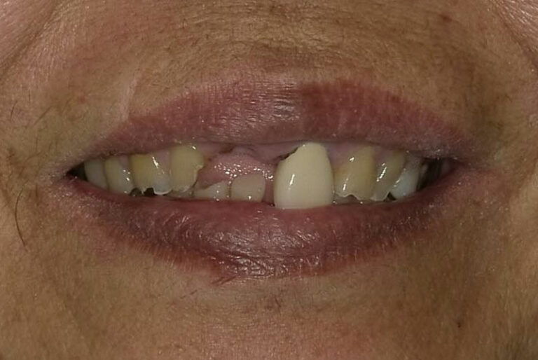 Before & After Photos Kuzma DDS Fairfield, CA